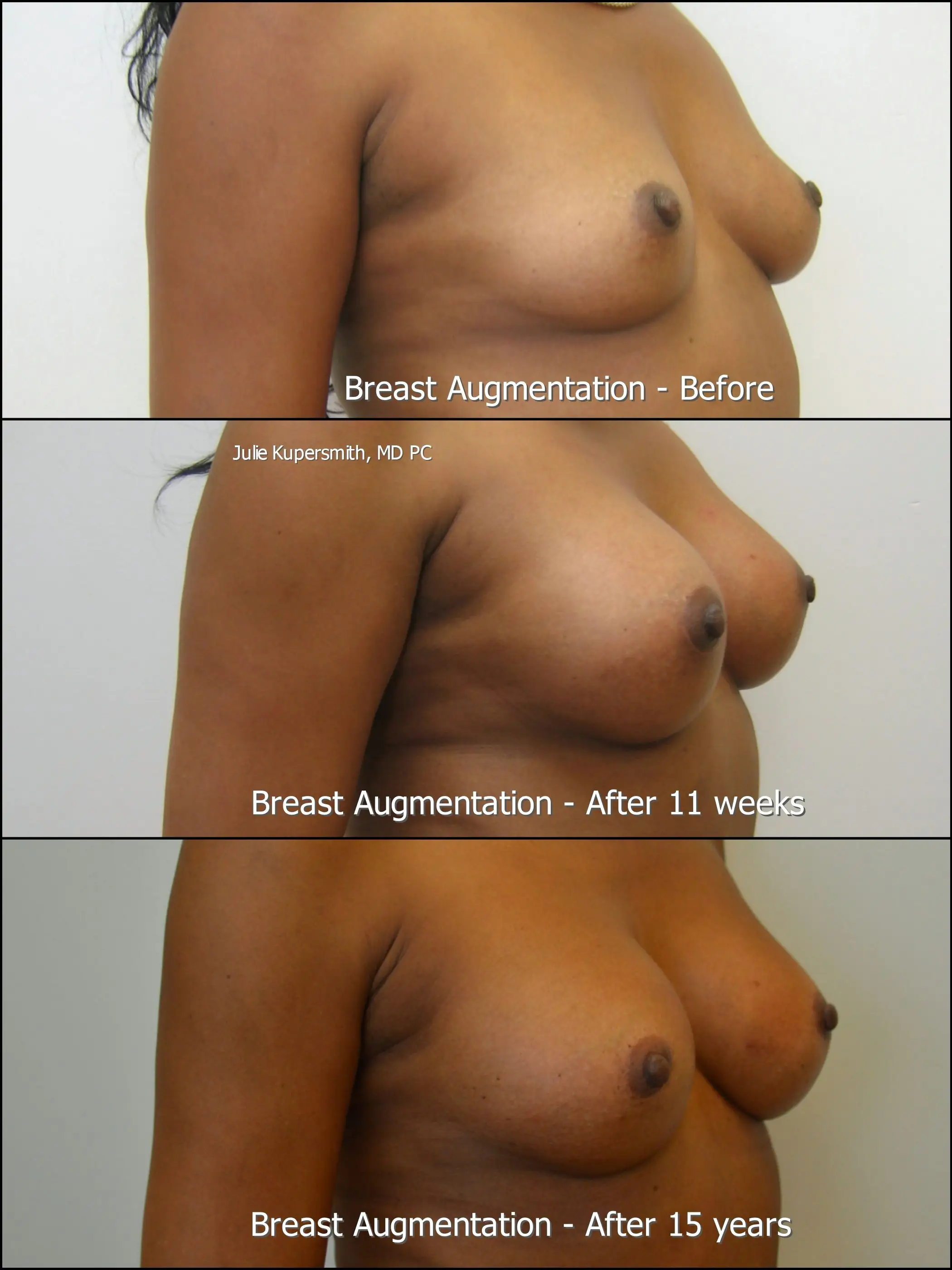 breast-augmentation gallery