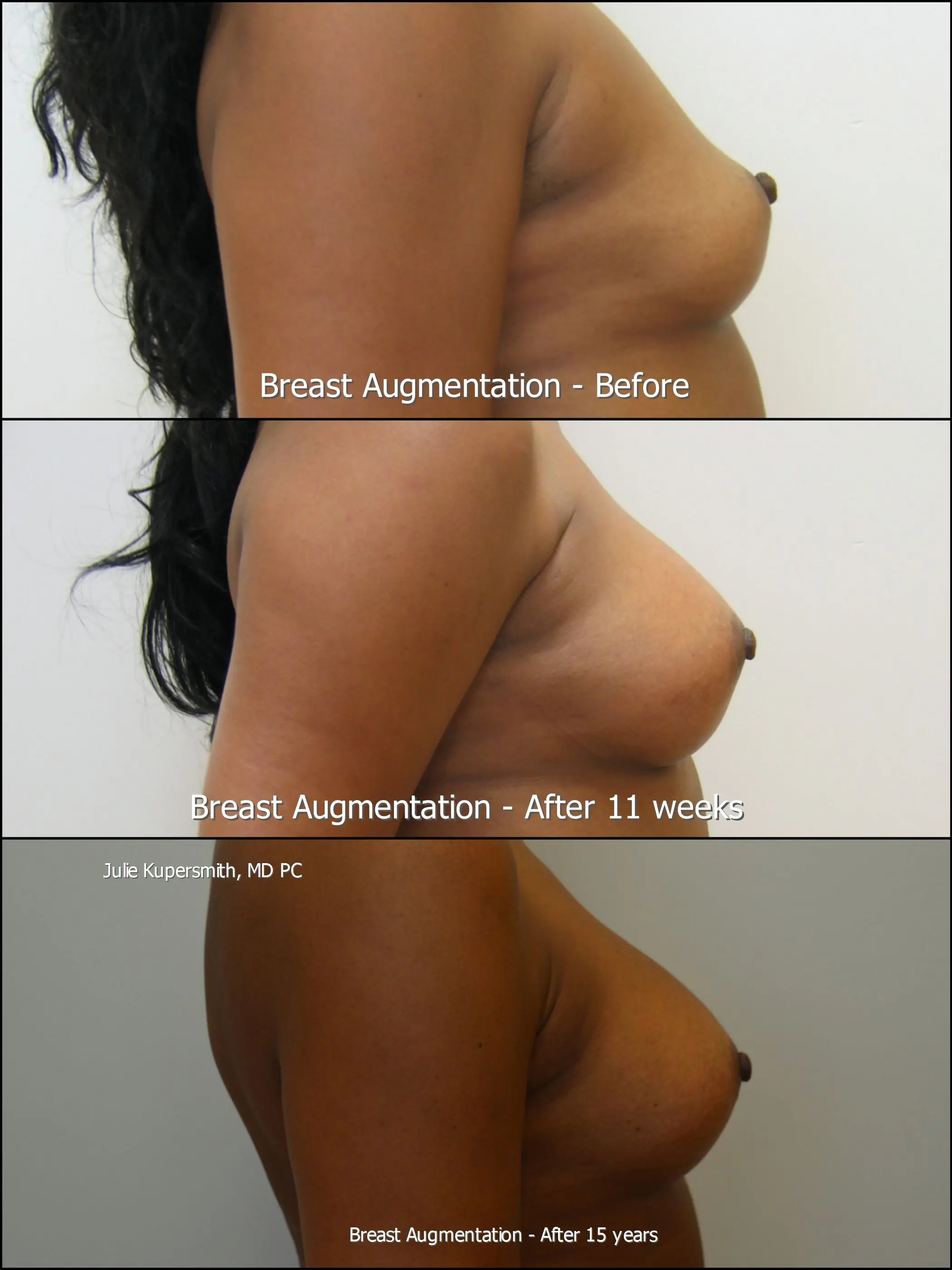breast-augmentation gallery