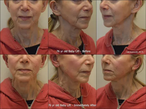 Before and after baby lift