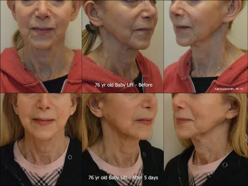 Before and after baby lift