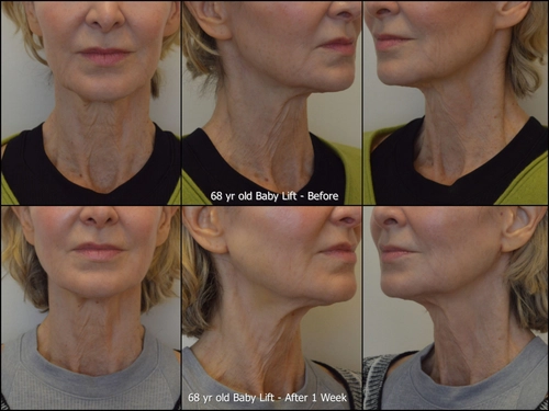 Before and after baby lift